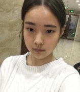 湖南湘雅醫(yī)院整形科價(jià)格表，附雙眼皮案例