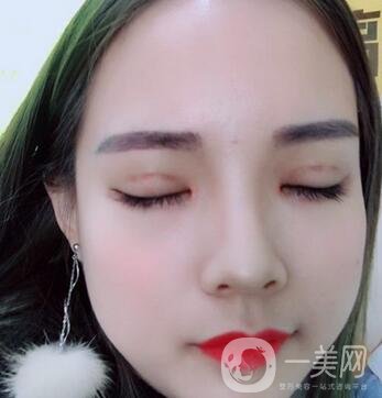 湖南第一醫(yī)院整形科價格表，附雙眼皮案例