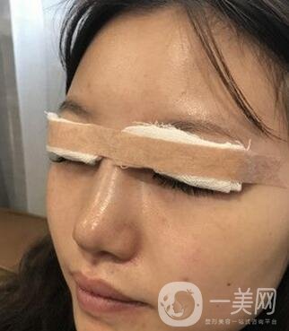 青島青醫(yī)附院整形價(jià)格表，還有雙眼皮實(shí)例