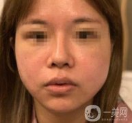 常州第一人民醫(yī)院*案例果及整形價(jià)格表分享