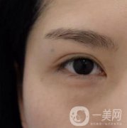 廣州人民醫(yī)院整形價(jià)格表，附去眼袋案例