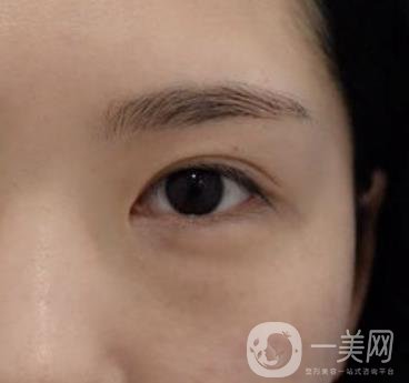 廣州人民醫(yī)院整形價(jià)格表，附去眼袋案例