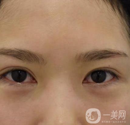 廣州人民醫(yī)院整形價(jià)格表，附去眼袋案例