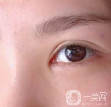 廣州人民醫(yī)院整形價(jià)格表，附去眼袋案例