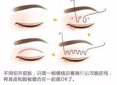 雙眼皮成型方法有哪些？好處有啥？