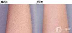 激光手臂脫毛之后會(huì)不會(huì)在長(zhǎng)？專(zhuān)家揭秘脫毛的優(yōu)點(diǎn)