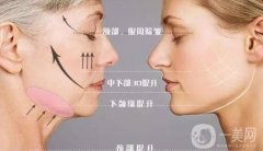 打了“*”就能消除魚(yú)尾紋！注射之前先了解這些幾點(diǎn)