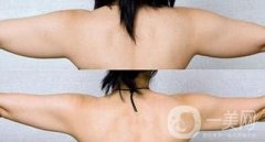 手臂抽脂后第二天可以上班嗎?手臂抽脂需要請(qǐng)假幾天?