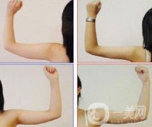 手臂抽脂疼嗎?手臂抽脂多久能恢復(fù)正常?