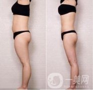腿部吸脂多少錢(qián)?腿部抽脂后需要注意什么?