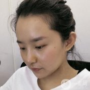 上海九院丁偉醫(yī)生隆鼻咋樣？收費(fèi)貴嗎？看價(jià)格收費(fèi)表&案例深入了解