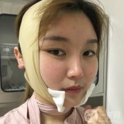湘雅三醫(yī)院整形科價(jià)格表全新出爐！磨骨案例果圖同步公開(kāi)~