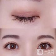 處雙眼皮價格多少?處的整形醫(yī)生怎么樣?
