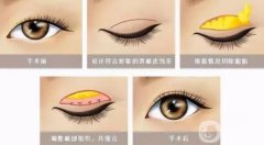 雙眼皮價格不一樣是怎么回事?雙眼皮多久能恢復(fù)自然?