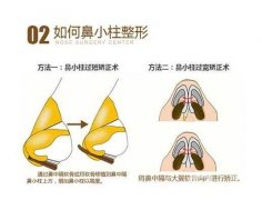鼻小柱延長會不會漏出鼻孔？延長鼻小柱的方法有哪些？