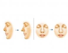 鼻小柱延長失敗如何修復(fù)？術(shù)后可能出現(xiàn)的風(fēng)險？
