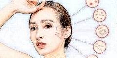 電波拉皮能去妊娠紋嗎?