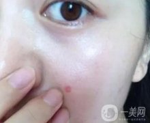 點(diǎn)痣后可以用護(hù)膚品嗎？有什么注意事項(xiàng)？