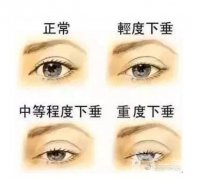 外眼角下垂嚴重可以做提拉嗎?