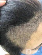 頭發(fā)種植后會不會留疤?種發(fā)前后注意事項有哪些?