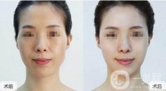 填充太陽穴有危險嗎?需要注意些什么?