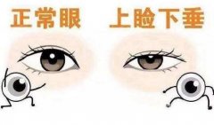 上瞼下垂能不做手術嗎?上瞼下垂不做手術該怎么改良?