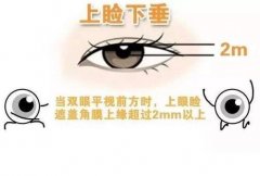 上瞼下垂矯正術需要多少錢?影響上瞼下垂手術價格的因素