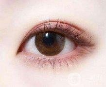 如果雙眼皮做寬了該怎么辦?