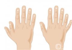 多指矯正術(shù)有哪些？手術(shù)后需要注意什么？