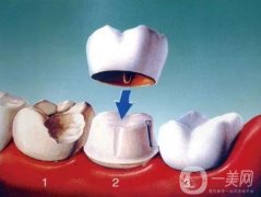 美容冠矯正牙的優(yōu)缺點(diǎn)是什么？美容冠矯正牙齒好嗎？