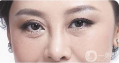 去除眼袋后有哪些禁忌呢?去除眼袋的果能維持多久?