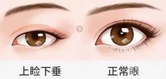 上眼瞼抽脂多少錢？上眼瞼抽脂疼嗎？