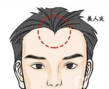 種植美人尖會有排異反應(yīng)嗎？種植美人尖注意事項有哪些？