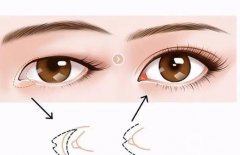 如何開眼角？做雙眼皮和開眼角的區(qū)別是什么？