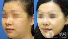 面部光纖溶脂會(huì)反彈嗎?光纖溶脂的原理是什么?