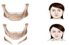 磨骨會(huì)改變臉型嗎?削骨和磨骨哪個(gè)更危險(xiǎn)一些?