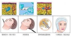 面部吸脂瘦臉多少錢?面部吸脂術(shù)后護(hù)理要素