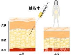 抽脂多少錢?抽脂減肥價(jià)格影響因素有哪些?