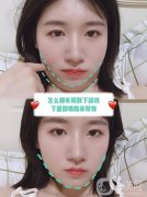 什么是激光消脂瘦臉?術(shù)后怎么護(hù)理?