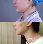 什么是光纖溶脂?用光纖溶脂可以解決哪些問題?