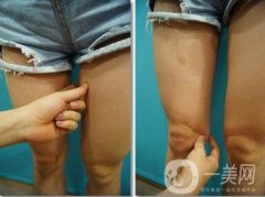 抽脂多少錢?小腿部抽脂貴嗎?