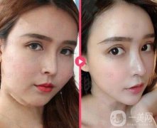 面部吸脂多少錢?