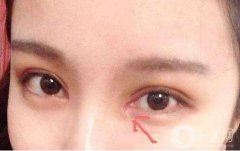 開內(nèi)眼角和外眼角有什么區(qū)別?