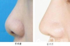 鼻尖延長整形手術(shù)選擇假體還是耳軟骨好?