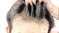 植發(fā)后脫發(fā)多長時間會再長?