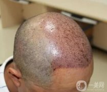 植發(fā)有沒(méi)有副作用?植發(fā)后能堅(jiān)持多久?