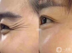 魚尾紋能注射注射除皺嗎?注射注射除皺后的注意事項?