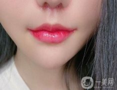 怎么做微笑唇整形手術(shù)？有什么風(fēng)險(xiǎn)？