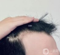 現(xiàn)在植發(fā)一般要多少錢？植發(fā)后有哪些注意事項(xiàng)？