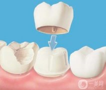 牙齒美容冠能管多久？美容冠矯正牙齒的建議？